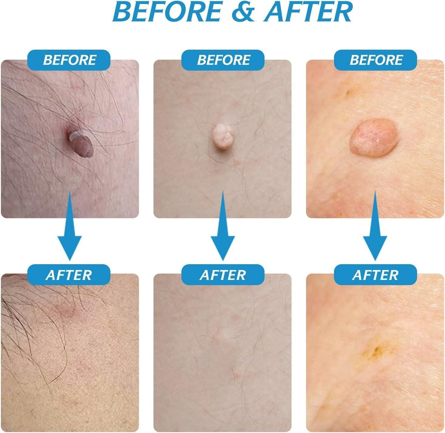 Painless Skin Tag Remover Device – At-Home Safe Skin Care Kit