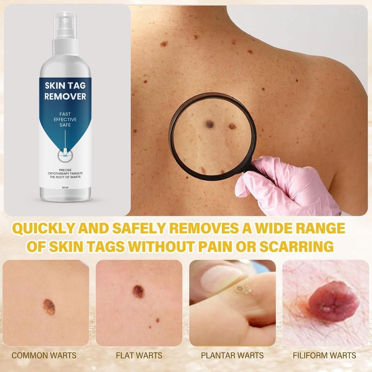 Powerful Skin Tag Removal Formula – 2 Bottles