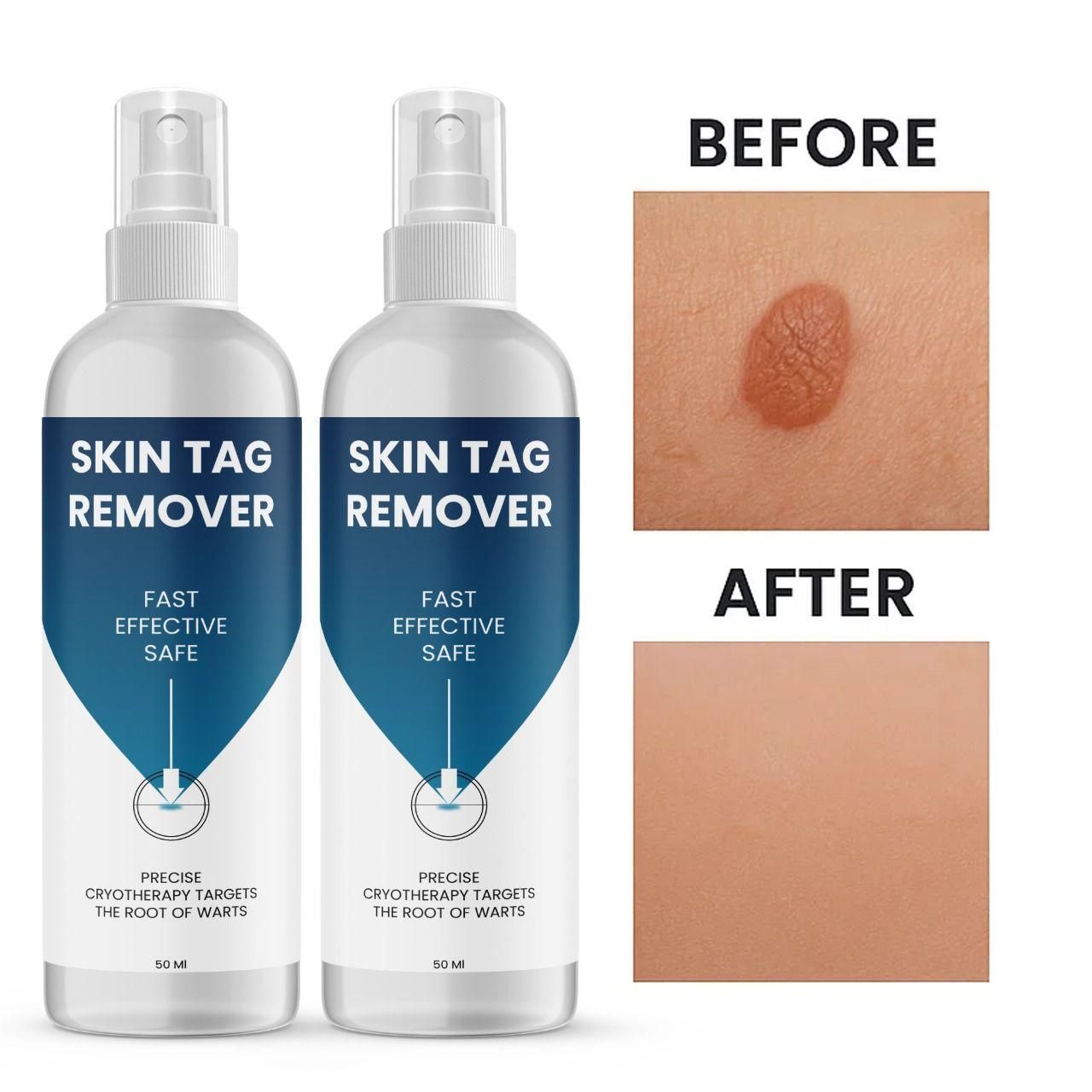 Powerful Skin Tag Removal Formula – 2 Bottles