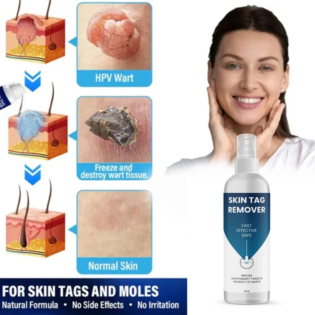Powerful Skin Tag Removal Formula – 2 Bottles